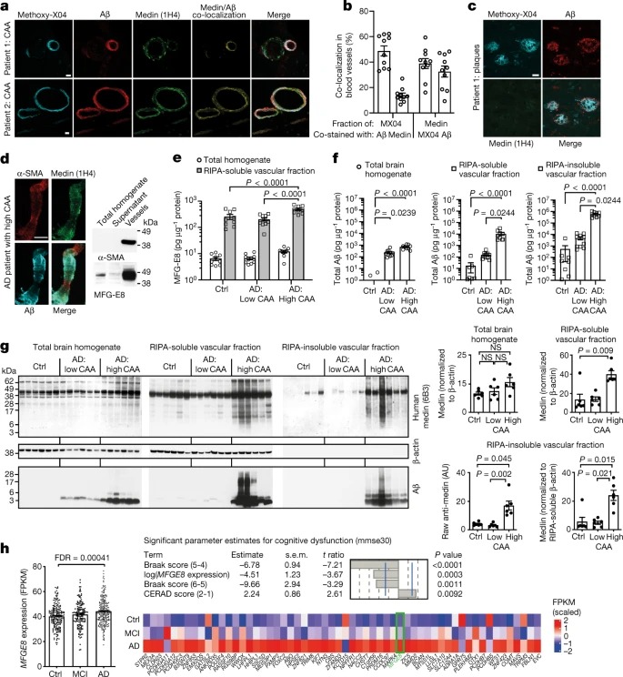 Medin co-aggregates with vascular amyloid-β in Alzheimer’s disease