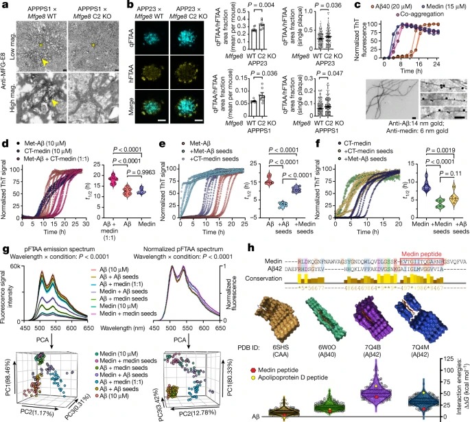 Medin co-aggregates with vascular amyloid-β in Alzheimer’s disease