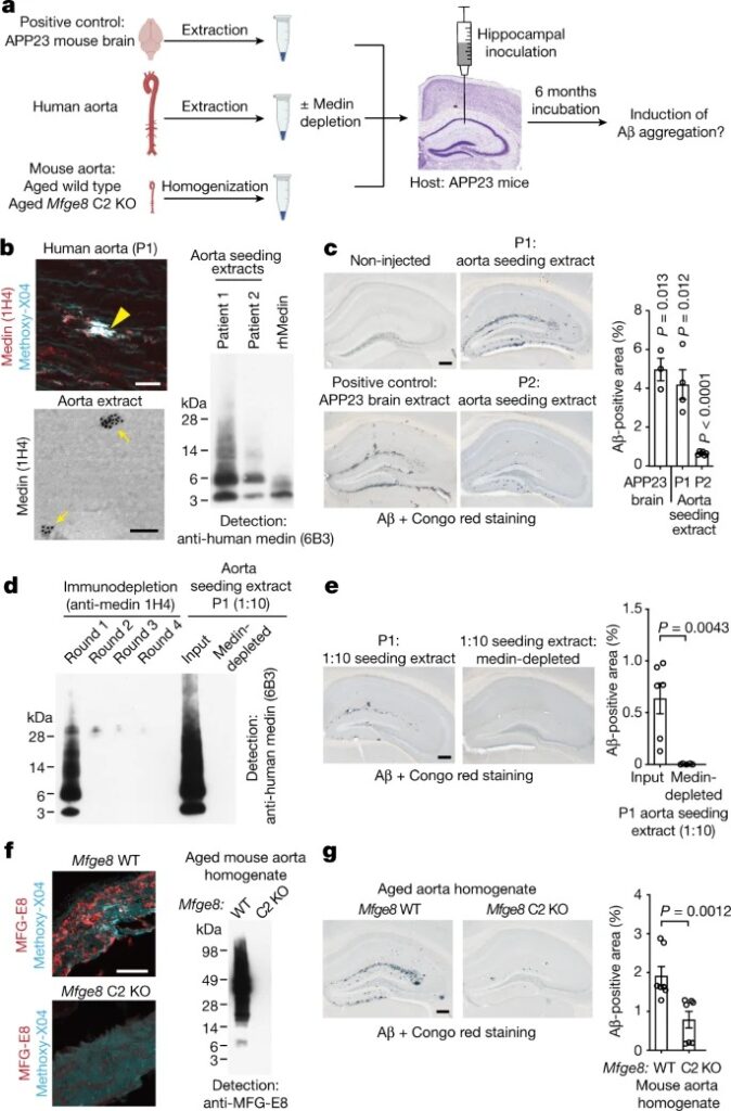 Medin co-aggregates with vascular amyloid-β in Alzheimer’s disease