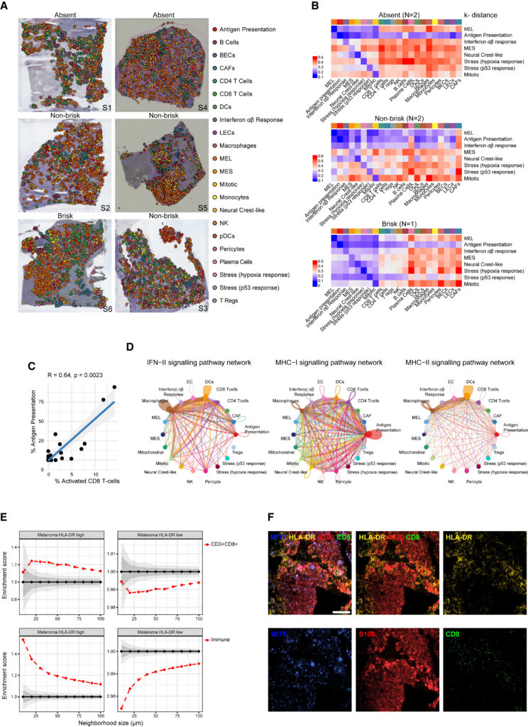 Fig 2: 공간적으로 매핑된 치료 경험이 없는 melanoma ecosystem